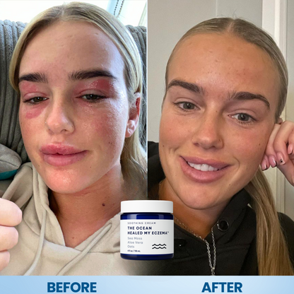 Evoulix™ Eczema Relief Cream